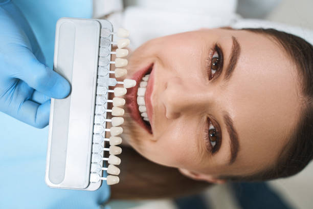 Dental Veneers
